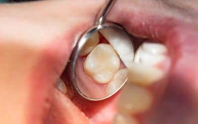 Dental Fillings: Everything You Need to Know in Franklin, TN