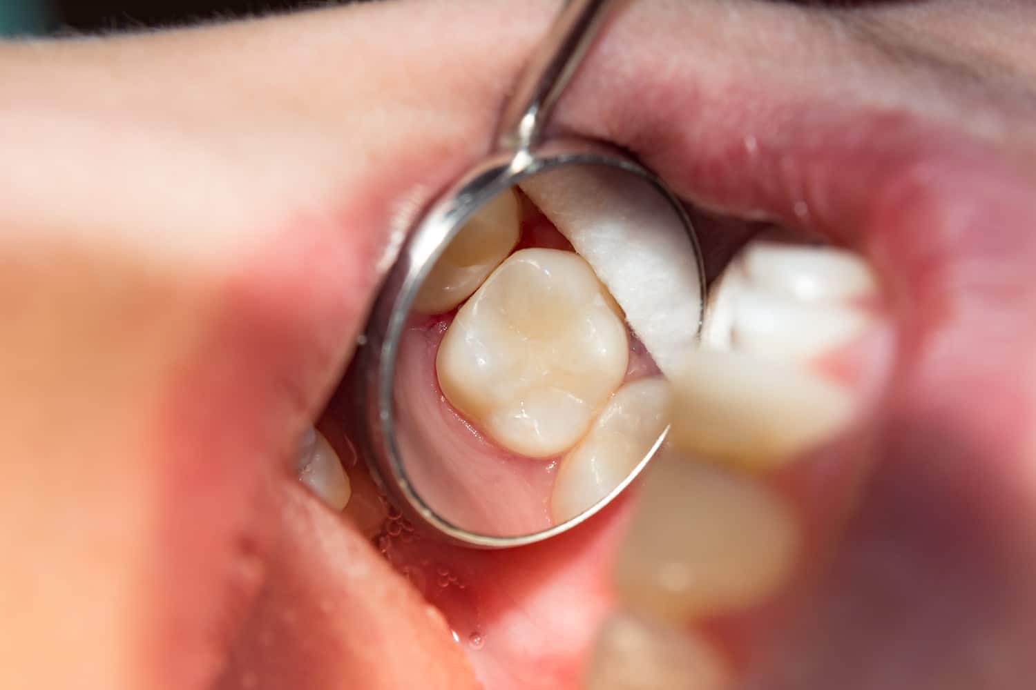 Patient with a dental filling in Franklin TN